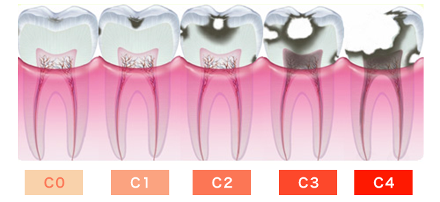C0からC4までの虫歯の進行具合