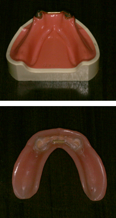 インプラント義歯模型