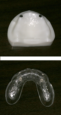 マグネット義歯の模型
