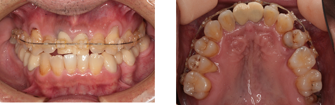 矯正治療写真