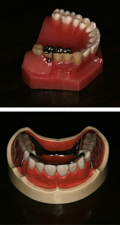 部分入歯の模型